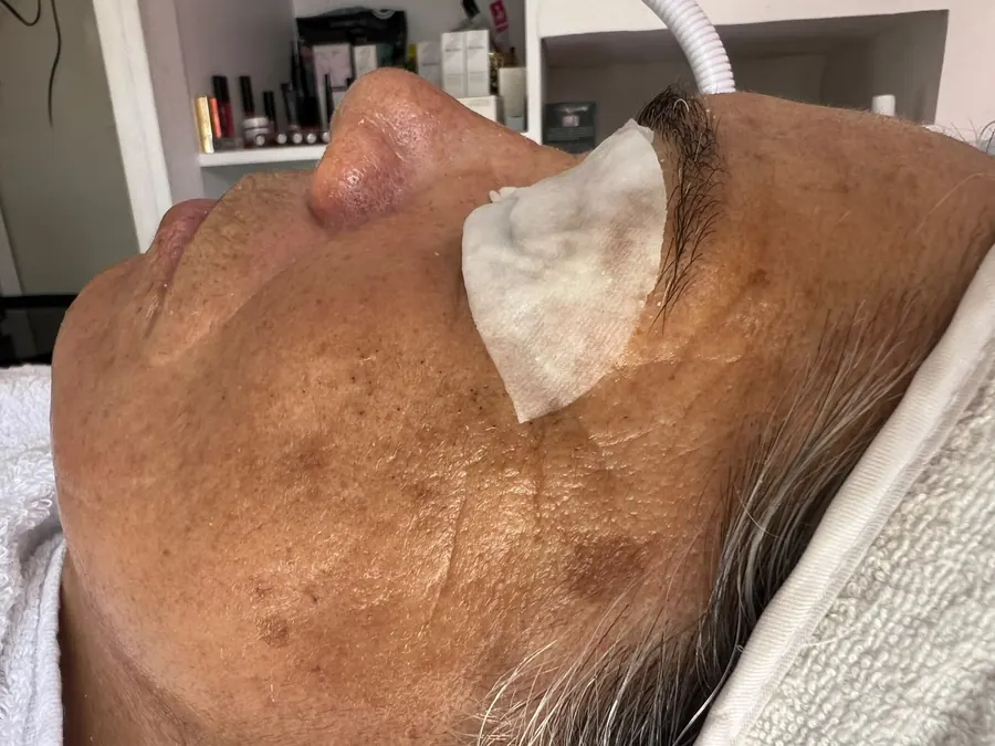 Limpieza facial: la piel antes del tratamiento, con algodón sobre el ojo
