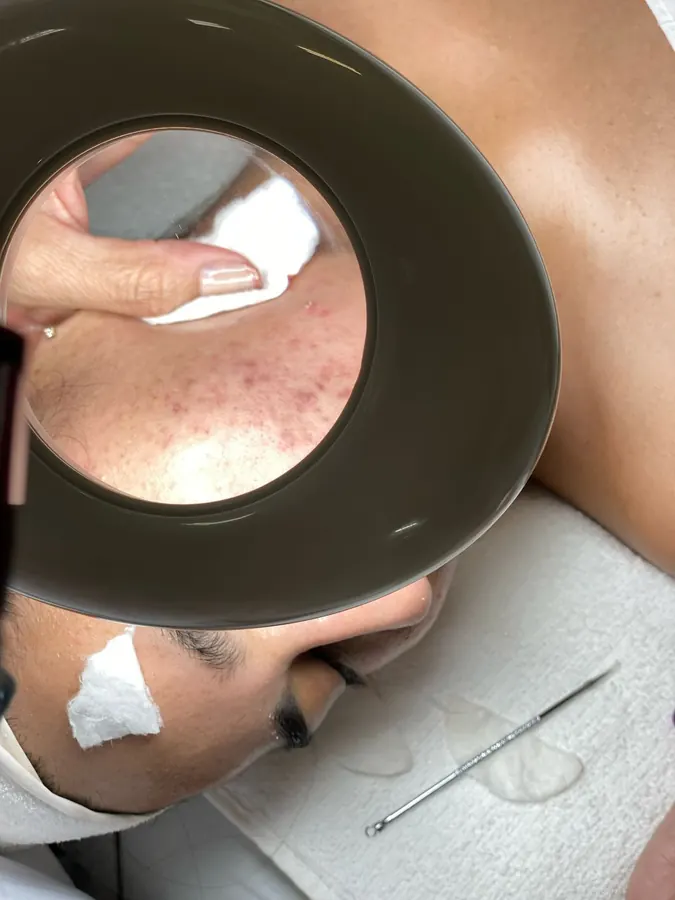 Limpieza facial: durante el tratamiento, con lámpara y algodón